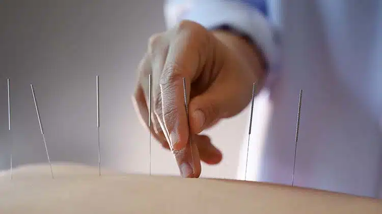 Acupuncture in Sherman Oaks